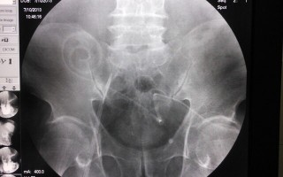 腹透，腹透和血液透析有什么区别