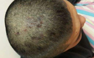 脂溢性皮炎症状，脂溢性皮炎症状表现