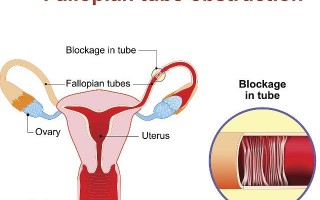 输卵管不孕，输卵管不孕好治疗吗